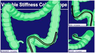 COLONOSCOPY Olympus Total [upl. by Papke]