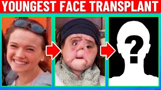 The Youngest Face Transplant Howd She Do [upl. by Winfrid]