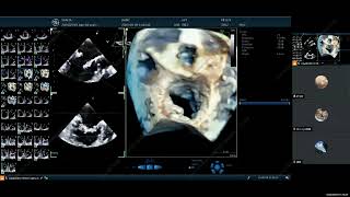 v clamp transcatheter edge to edge repair in mmvd patient KAMC Korea Animal Medical Center 엽경아 [upl. by Thanos82]