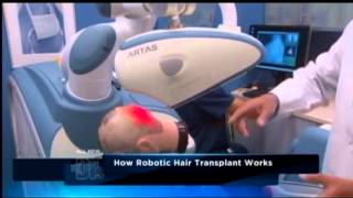 Robotic Hair Transplant Surgery  ARTAS Hair Restoration [upl. by Bollay]