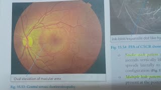 Central Serous Chorioretinopathy  EYE [upl. by Mazel702]