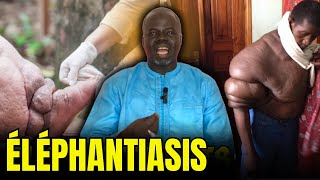 Éléphantiasis 1   Causes et Conséquences   Pr Ousmane Ndiaye  SAMA XALAAT TV [upl. by Ailati]