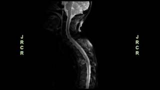 Radiology video Aggressive Adenoid Cystic Carcinoma With Asymptomatic Spinal Cord Compression [upl. by Aniaz745]