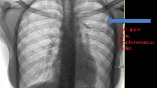 CASE 291 LEFT UPPER EMPHYSEMATOUS BULLAE [upl. by Dnomed489]