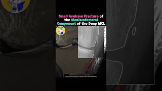 Fig 3A22 Avulsion fracture of meniscofemoral ligament [upl. by Kopple471]