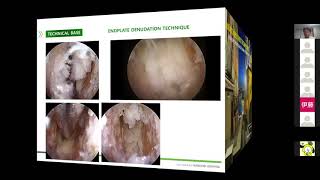 Biportal Endoscopic UBE TLIF with Enhanced Recovery After Surgery ERAS Concept [upl. by Marita]