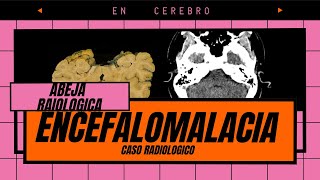 🧠🚨🔼 ENCEFALOMALACIA EN EL CEREBRO 🧠🚨🔼 [upl. by Camilia529]