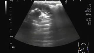 Ultrasound Video showing Lymphadenopathy splenomegaly amp hepatomegaly in a child of about 3 years [upl. by Cobbie]