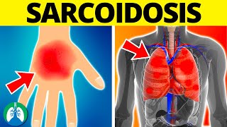 Sarcoidosis Medical Definition  Quick Explainer Video [upl. by Allrud]