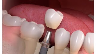 What is a periodontist [upl. by Drofdeb]