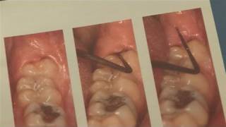 How To Alleviate Infected Wisdom Tooth [upl. by Netsirt]