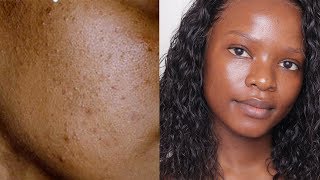 HOW I CLEARED MY SKIN  DARK SPOTS MILD ACNE AND HYPERPIGMENTATION [upl. by Irtemed]