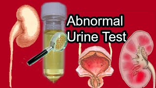 Urinalysis Hematuria Proteinuria Leukocyturia Glucosuria ketonuria [upl. by Salomon]