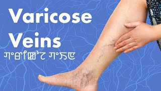 Varicose Veins ꯚꯦꯔꯤꯀꯣꯖ ꯚꯦꯏꯟ [upl. by Llenroc]