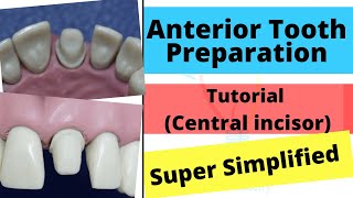 Anterior Crown Preparation  Demonstration Super Easy [upl. by Oinimreh]