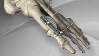 First Metatarsophalangeal Joint Fusion with Arthrex® MTP Fusion Plate [upl. by Airetnuhs804]