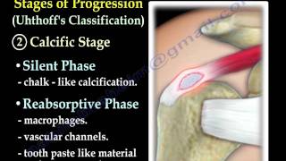 Calcific Tendonitis  Everything You Need To Know  Dr Nabil Ebraheim [upl. by Alrak]