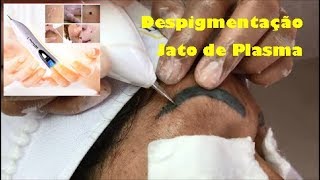 DESPIGMENTAÇÃO COM JATO DE PLASMA Protocolo Despigmentação de Sobrancelhas [upl. by Airdnaid768]