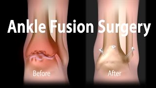 Ankle Fusion Surgery Animation [upl. by Fattal]