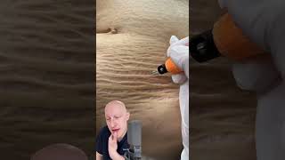 Plasma Pen As A Cure For Stretchmarks  Doctor Reacts [upl. by Anassor201]