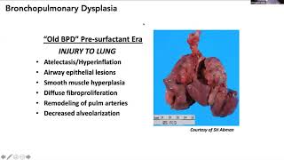 Virtual FTS Pediatric Session Bronchopulmonary Dysplasia [upl. by Kosak]