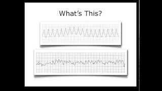 ECG Heart Rhythm Review [upl. by Helga75]