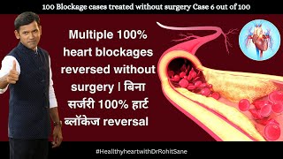 Multiple 100 heart blockages reversed without surgery  बिना सर्जरी 100 हार्ट ब्लॉकेज reversed [upl. by Ised]