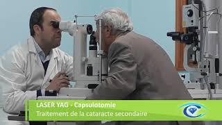 Traitement de la cataracte secondaire par le laser Capsulotomie YAG [upl. by Aiela]