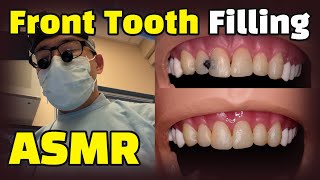 How to fix cavities between front teeth  Dental ASMR Composite Resin Filling Procedure Explained [upl. by Nevanod]