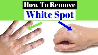 White spots on skin Best 4 remedies to treat it [upl. by Eidnarb]