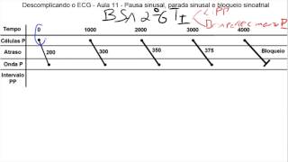 Descomplicando o ECG  Aula 11 Parte 2  Bloqueio Sinoatrial [upl. by Sidonnie795]