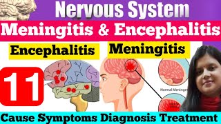 Meningitis amp Encephalitis Cause Symptom Diagnosis Treatment  What is Meningitis amp Encephalitis [upl. by Phaidra]