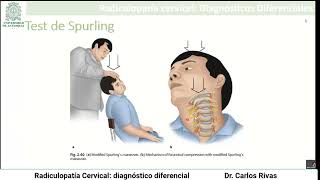 Radiculopatía cervical diagnóstico diferencial [upl. by Faustine]