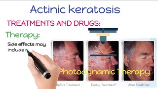 How To Treat and Remove Actinic Keratosis  Actinic Keratosis Treatment And Removal Procedures [upl. by Laetitia]