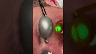 Dr Molinari  Laser à colorant pulsé V Beam  couperose visage [upl. by Imiaj469]