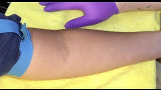 Tips For Locating Difficult Veins [upl. by Waldon324]