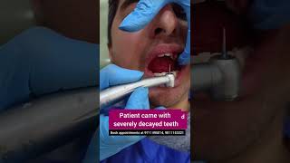 Smile Makeover with CAD CAM Zirconia crowns Dr Srishti Bhatia teethdecay dentist [upl. by Laud]