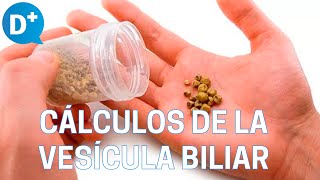 Causas y síntomas de los cálculos de la vesícula biliar [upl. by Leshia]