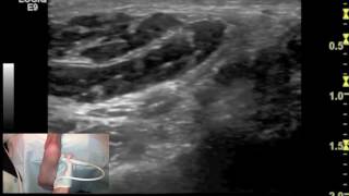 Ultrasound tutorial  Imaging of the flexor hallucis longus tendon [upl. by Arramahs27]