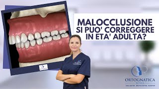 Malocclusioni dentoscheletriche è possibile correggerle in età adulta [upl. by Garvy]