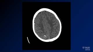 Neuroradiology board review lecture 1 case 12 [upl. by Emmer]