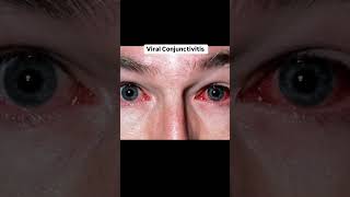 Know about conjunctiva disease 🩺✨💉🥀 love optometrist doctor optometry music mbbs doctor [upl. by Stefano309]