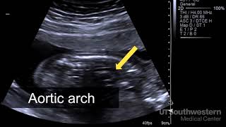 Understanding your fetal ultrasound [upl. by Raclima]