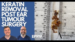 KERATIN REMOVAL POST EAR TUMOUR SURGERY  EP919 [upl. by Cosette138]