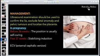 Malpresentation 2  OB course  Masterclass Medicine [upl. by Nailluj95]