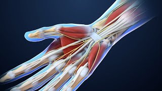 Carpal Tunnel Syndrome  Nucleus Health [upl. by Enomis442]