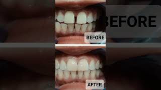 Diastema closure  Dokter Gigi Cuspaeni dentalcare dentist doktergigiindramayu directcomposite [upl. by Hegyera]