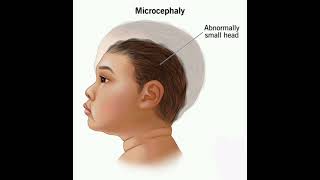 Microcephaly History mrcpch Clinical [upl. by Nnylyahs]