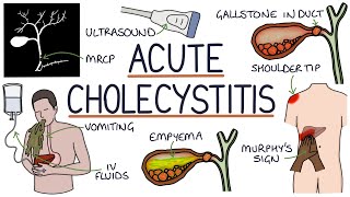 Understanding Acute Cholecystitis [upl. by Durstin]