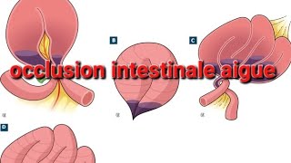 OCCLUSION INTESTINALE AIGUE [upl. by Ceciley]